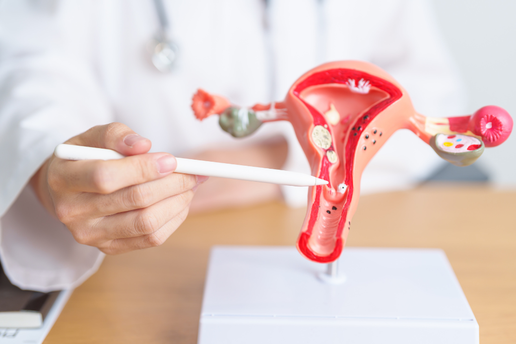 How To Cure PCOS Permanently: A Comprehensive Guide